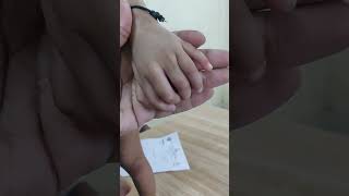 Polydactyly orthopedicshortcase pediatricorthopedics [upl. by Yrahcaz]