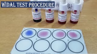 Widal Test।। Widal Test Practical Procedure for Typhoid amp ParaTyphoid Fever full Details [upl. by Jahn645]