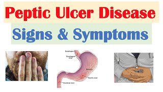 Peptic Ulcer Disease Signs amp Symptoms  Gastric vs Duodenal Ulcers [upl. by Ahsart]