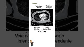 TC DE TÓRAX radiologia tecnologoemradiologia tomografia [upl. by Okihsoy883]