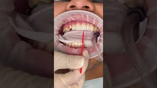 Porcelain veneers procedure  porcelain veneers before and after  smile makeover  Dr Yazdan [upl. by Russo184]