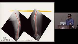 Unbelievable Transformation How We Corrected a Femur Malunion [upl. by Nudnarb543]