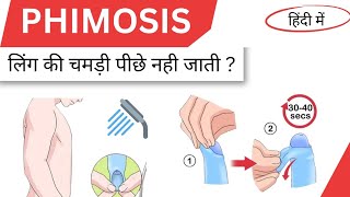 Phimosis causes symptoms and treatment in hindi [upl. by Oine]