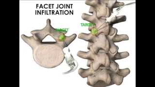 ULTRASOUND GUIDED FACET JOINT AND MEDIAL BRANCH INFILTRATION [upl. by Tacita44]