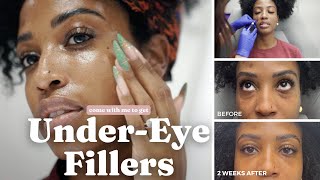 I Got Under Eye Fillers  Before After and During  Very Detailed [upl. by Enneillij908]