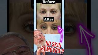 Before Removing Skin Try This Instead [upl. by Ayekel549]