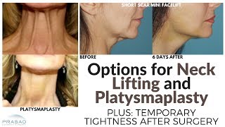 Why Platysmaplasty is Usually Done with a Face andor Neck Lift and Tightness after Surgery [upl. by Anahsar]