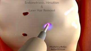 Endometriosis Hirsutism amp Laser Hair Removal Miami Beach Fl [upl. by Obbard199]