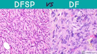 DFSP vs DF dermatofibrosarcoma protuberans vs dermatofibroma pathology dermatology dermpath [upl. by Gemperle61]