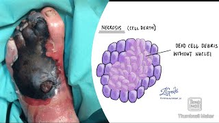 Necrosis and its types coagulative liquefactive caseous fat fibrinoid necrosis fmge neetpg [upl. by Audrey529]