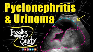 Pyelonephritis with Urinoma  Ultrasound  Case 234 [upl. by Richarda]