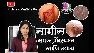 नागीन बद्दल चे समज गैरसमजआणि उपाय Understanding Herpes ZosterNagin NagvedhaShingles and Diagnostic [upl. by Chard]