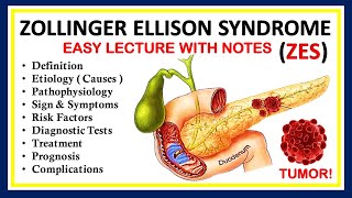 Zollinger Ellison Syndrome ZES Definition Causes Symptom Diagnosis Pathophysiology amp Treatment [upl. by Josepha]