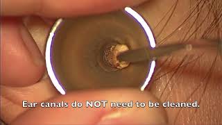 Ear Wax Extraction  St Pauls Hospital [upl. by Saville]