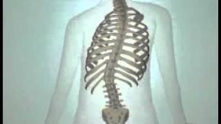 Teen Scoliosis Causes and Treatment Options DePuy Videos [upl. by Nahtanod189]