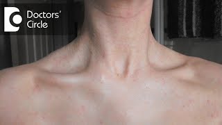 What causes a sudden red rash around the neck in women  Dr Aruna Prasad [upl. by Deer]