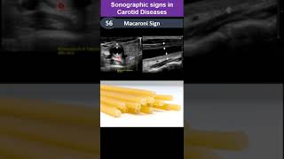 Sonographic Signs In Carotid Diseases [upl. by Aronel]