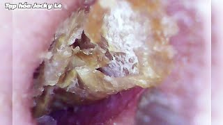 Ear Wax Removal 111 The Earwax Was So Big That He Couldnt Sleep  Ear Cleaning ASMR [upl. by Nani]