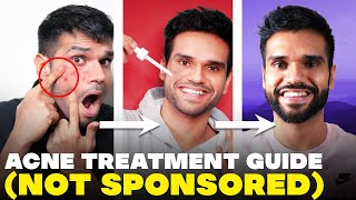 PIMPLE pe thook mat bro Acne Treatment Guide  How To Remove Acne  BeYourBest Skincare San Kalra [upl. by Eitsirk]