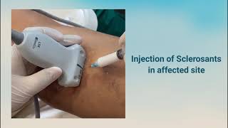 Sclerotherapy for Venous Malformation [upl. by Bethanne652]