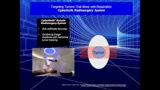 Moving Tumor Targeting Methods Outlined  CyberKnife vs Gating and Breathholds  IMRTIGRT [upl. by Neraa]