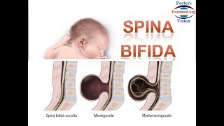 Spina Bifida les Causes et la Prévention par acide folique vitamine B9 [upl. by Bugbee]