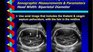 Gestational Age Determination by Ultrasound [upl. by Nylekcaj]