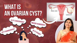 What is an Ovarian Cyst  Dr Anjali Kumar  Maitri [upl. by Cilo]