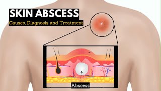 Skin Abscess Causes Signs and Symptoms Diagnosis and Treatment [upl. by Ahselrak272]