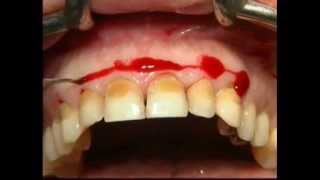 Gingival Surgery  External Bevel [upl. by Ambrosius810]