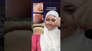 Best Remedy to remove texture from skin skincare beauty fyp trending [upl. by Gypsy]