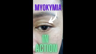 SEE MYOKYMIA IN ACTION  Eyelid Twitching shorts [upl. by Gibson]