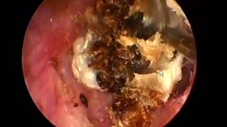 Earwax Removal Extractions Cholesteatoma clean外耳道挖耳屎清理，外耳道胆脂瘤后续 耳垢 耳垢 [upl. by Peednam]