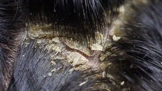 Dandruff scratching removal on head using black combing403 [upl. by Vardon580]