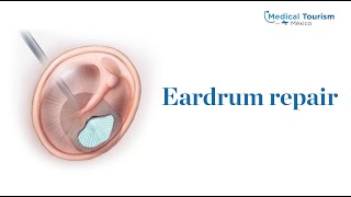 Eardrum repair  Medical Tourism Mexico [upl. by Latyrc368]