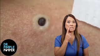 85 Year Old Blackhead Dr Pimple Popper Most Popular Pop of ALL TIME [upl. by Htennek379]