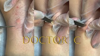 cleaning infected ingrown hair [upl. by Aneerehs]