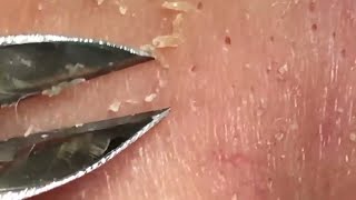 Tweezer Masterclass Ultimate Blackhead Extractions [upl. by Kampmann]