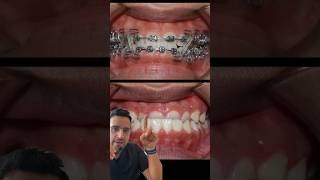 Cas ORTHODONTIE  l’INVERSÉ d’occlusion DENTAIRE [upl. by Netsriik931]