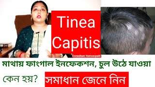 Tinea Capitis চুলের ফাংগাল ইনফেকশন  চুল পড়ে যাওয়া। [upl. by Airda]