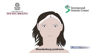 Biallelic deletions of the Waardenburg II syndrome gene SOX10 cause a recognizable arthrogryposis [upl. by Denni73]