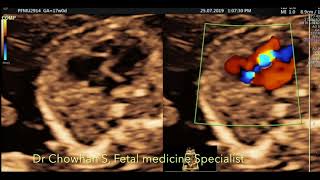 Ebsteins anomaly by Dr Chowhan S Fetal Medicine Specialist [upl. by Kilbride]