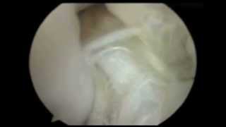 Canine Partial ACL Tear [upl. by Razaele]