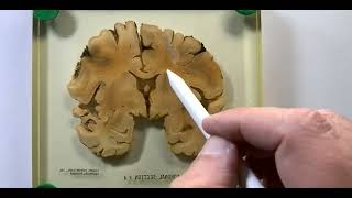 Sectional Anatomy of the Brain  Coronal Sections [upl. by Karalee]