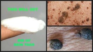 HOW TO GET RID OF SKIN TAGS AT HOME USING 2 INGREDIENTS  BAKING SODA  CASTOR OIL  Khichi Beauty [upl. by Rockefeller]