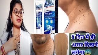 Wart Remover Ointment Honest Review2024Wart Remover ointment best usesampside effects review inhindi [upl. by Rotce]