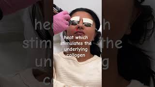 Collagen Production with Instant Glow Laser Facial ✨ laserfacial collagen laseraway [upl. by Bechler193]