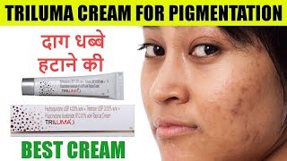 Triluma Cream for Pigmentation  Melasma  Triluma Cream Review in Hindi [upl. by Akinak]