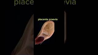 Placenta praevia shorts anatomy placentaprevia placenta gynecology [upl. by Aleyam935]