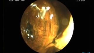 Direct Cholangioscopy with Standard Ultraslim Endoscopes [upl. by Derfnam]